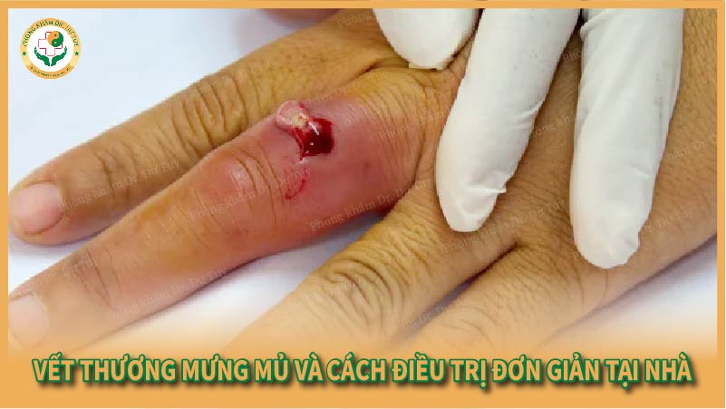 Vết thương mưng mủ và cách điều trị đơn giản tại nhà