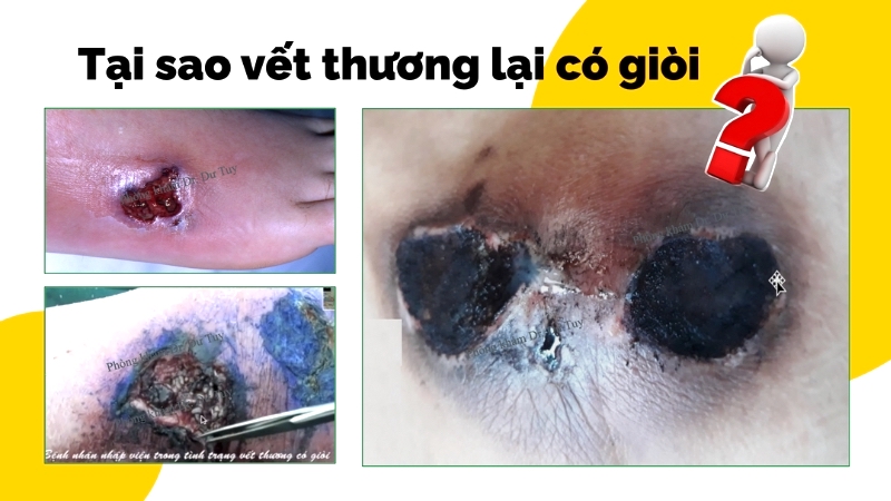vết thương ngoài da nhỏ dễ bị chủ quan