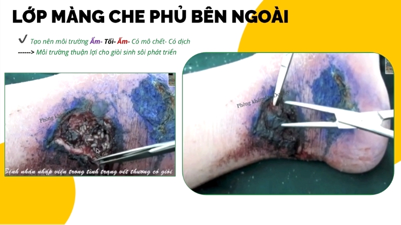 vết thương nhiễm giòi myiasis nang