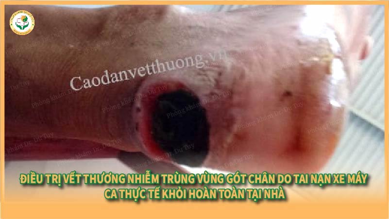 Điều trị vết thương nhiễm trùng vùng gót chân do tai nạn xe máy – Ca thực tế khỏi hoàn toàn tại nhà