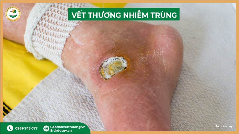 vết thương nhiễm trùng