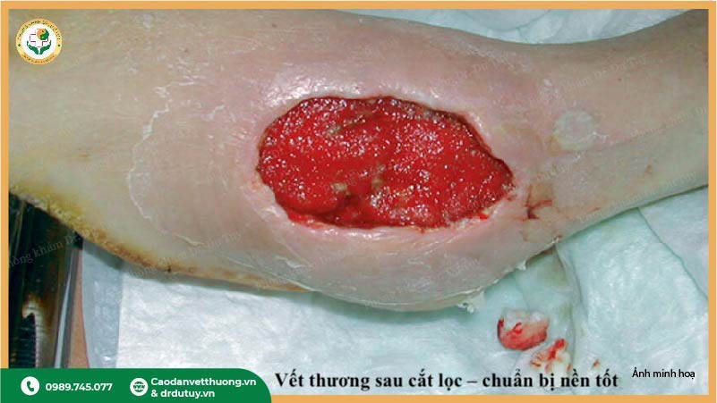 vết thương sau cắt lọc chuẩn bị điều trị VAC
