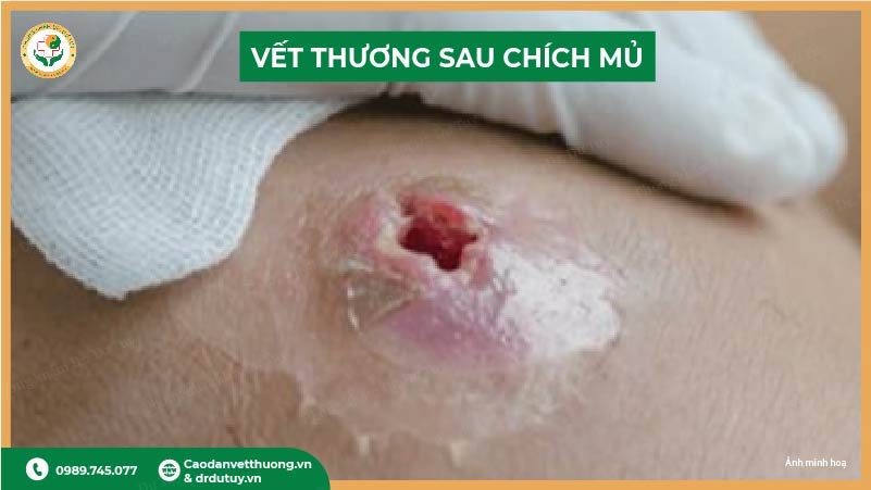 vết thương sau chích mủ áp xe