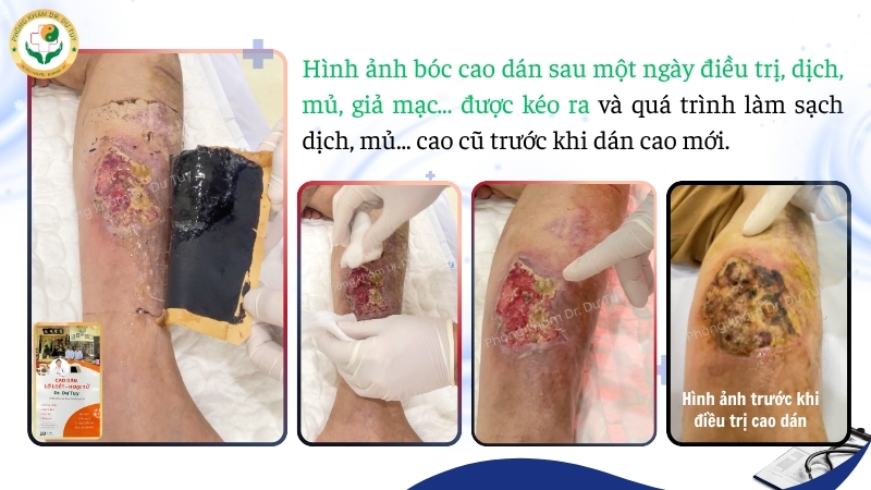 vết thương sau một ngày dùng cao dán