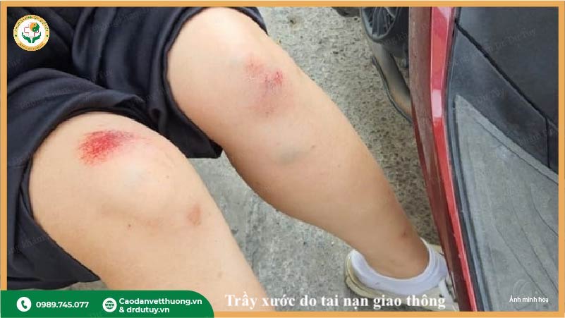 vết thương trầy xước do tai nạn giao thông