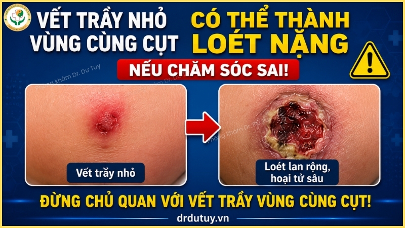 vết trầy nhỏ vùng cùng cụt thành loét nặng