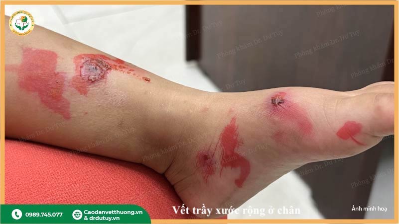 vết trầy xước chân trẻ đỏ sưng lâu lành