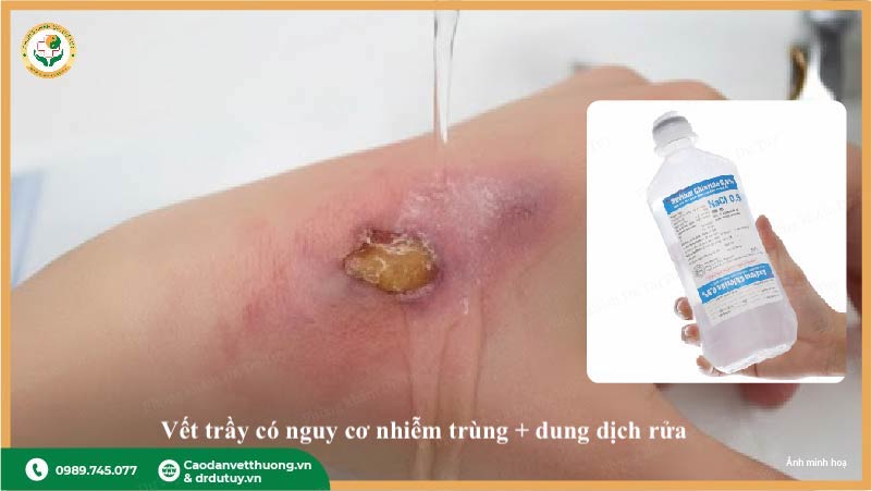 vết trầy xước nhiễm trùng cần lưu ý