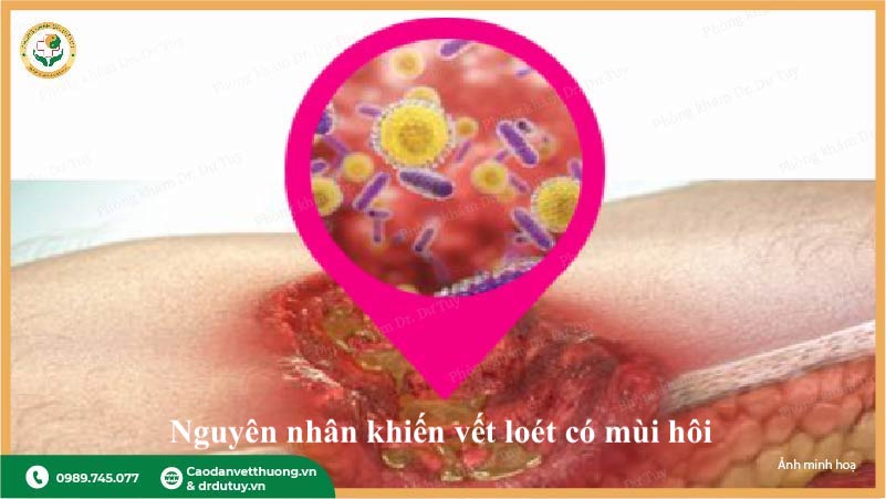 vi khuẩn gây mùi hôi trong vết loét nhiễm trùng
