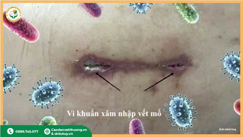vi khuẩn xâm nhập gây nhiễm trùng vết mổ