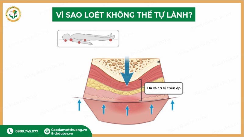 vì sao loét tỳ đè không thể tự lành