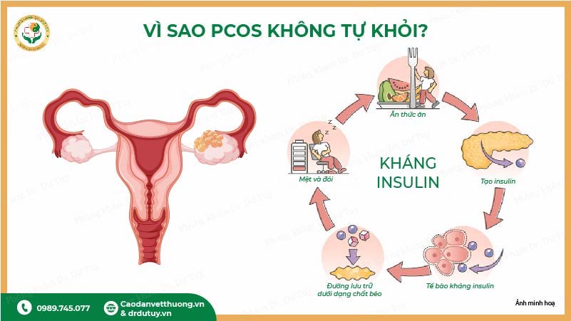 vì sao pcos không tự khỏi kháng insulin