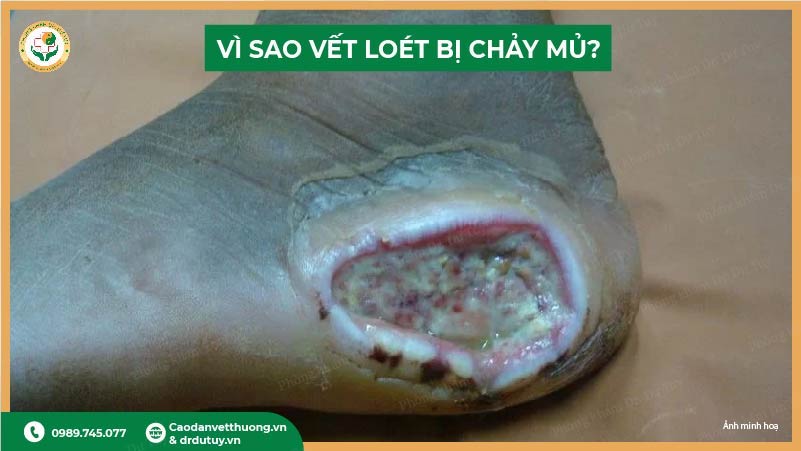 vì sao vết loét bị chảy mủ