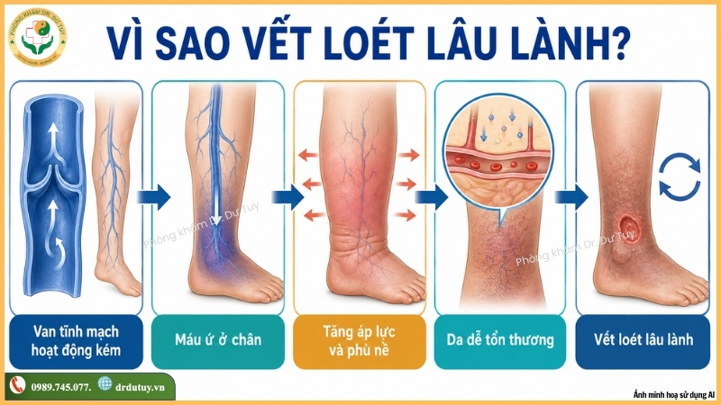 vì sao vết loét tĩnh mạch lâu lành