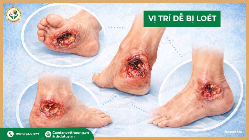vị trí dễ bị loét bàn chân tiểu đường