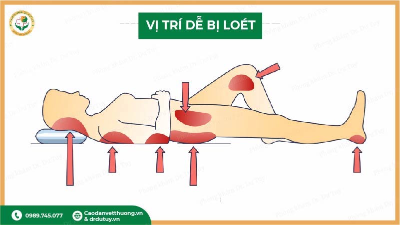 vị trí dễ bị loét tì đè