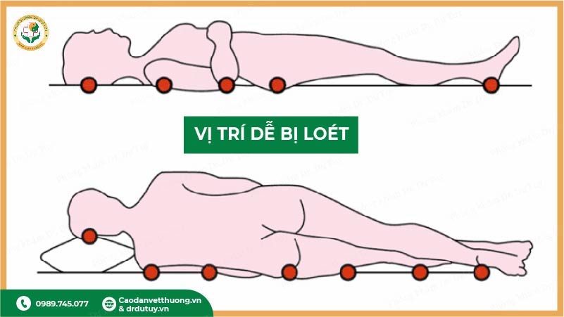 vị trí dễ bị loét tỳ đè