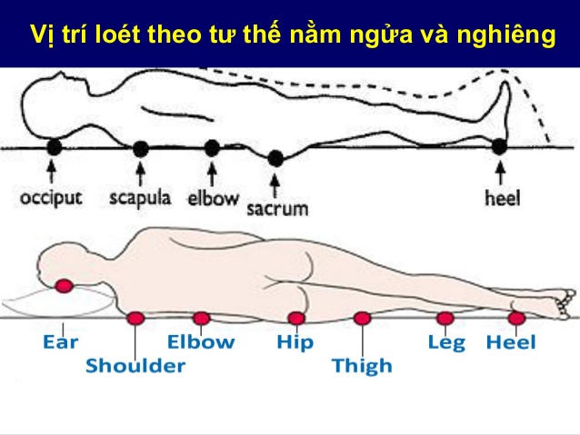 vi-tri-loet-ti-de-thuong-xuat-hien-o-nguoi-benh-nam-liet