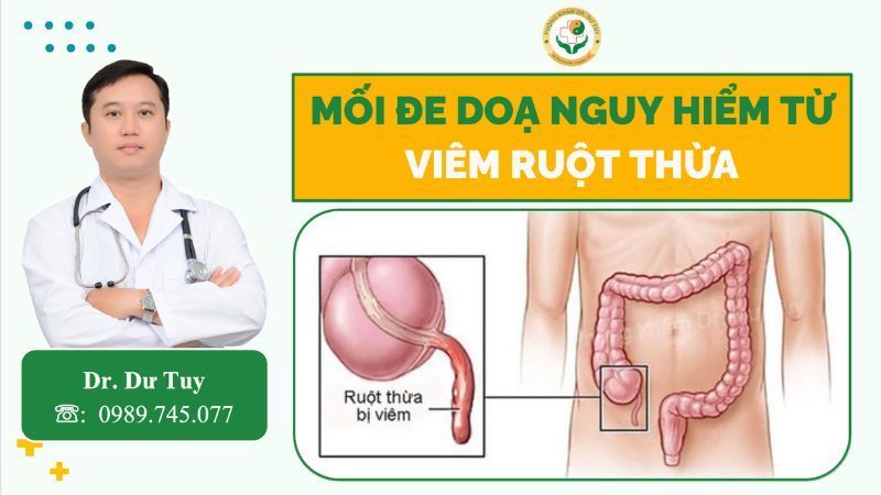 vị trí ruột thừa hố chậu phải trong ổ bụng
