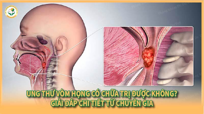 Ung thư vòm họng có chữa trị được không? Giải đáp chi tiết từ chuyên gia