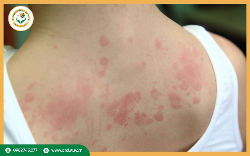 Viêm da cơ địa là gì? Nguyên nhân, triệu chứng và cách điều trị hiệu quả