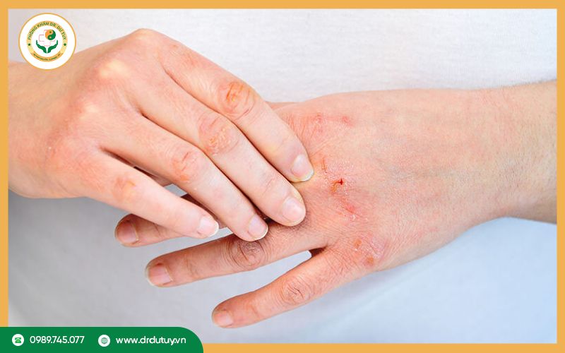 Biến chứng viêm da cơ địa