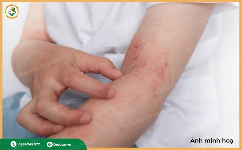 viem da cơ địa trẻ nhỏ