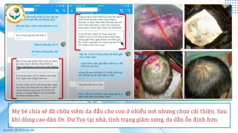 viêm da đầu trẻ em feedback thực tế