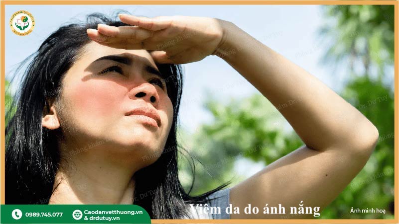 viêm da do nắng nguyên nhân kích ứng da