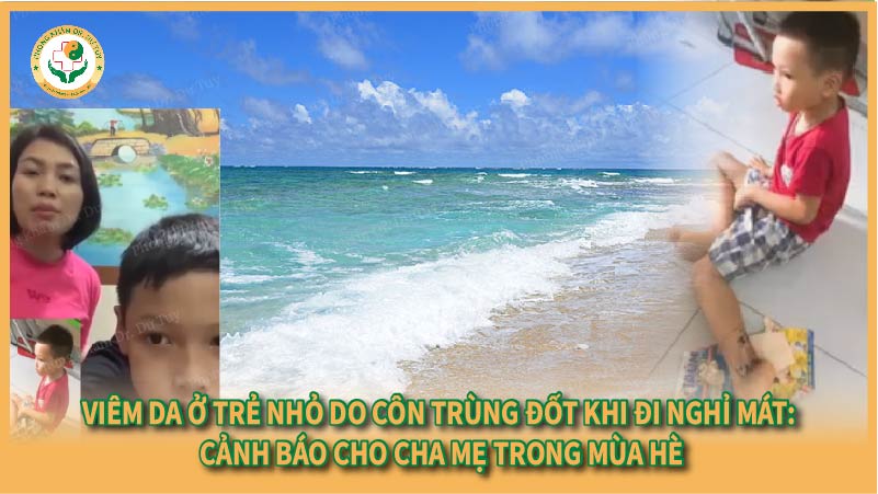 Viêm da ở trẻ nhỏ do côn trùng đốt khi đi nghỉ mát: Cảnh báo cho cha mẹ trong mùa hè