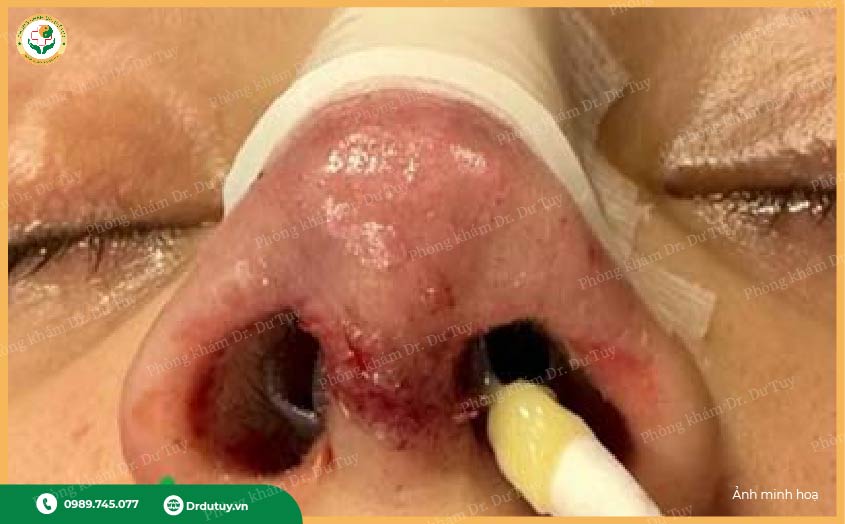 viêm da sau thẩm mỹ