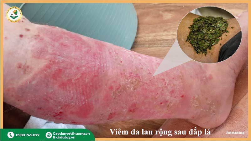 viêm da tiếp xúc do đắp lá cây