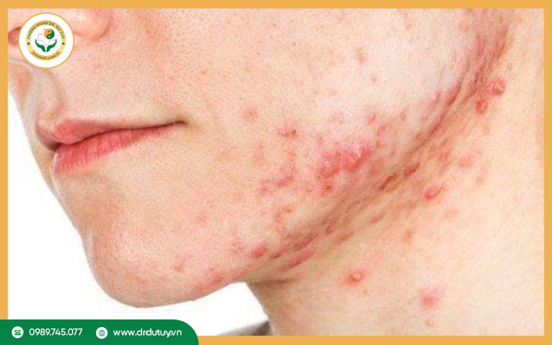 Viêm da tiết bã là gì?