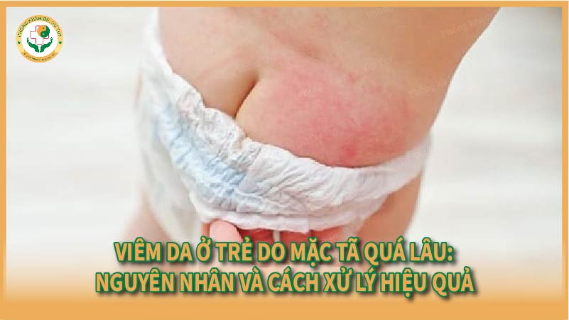 Viêm da ở trẻ do mặc tã quá lâu: Nguyên nhân và cách xử lý hiệu quả
