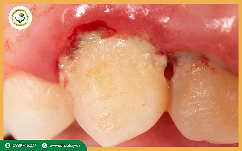 Viêm lợi loét hoại tử cấp: Nguyên nhân, triệu chứng và cách điều trị