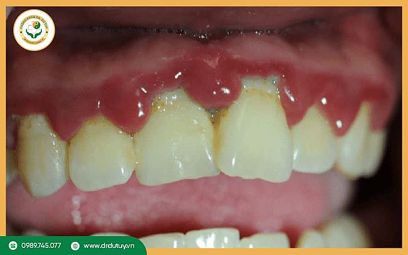 Viêm lợi loét hoại tử cấp là bệnh gì?