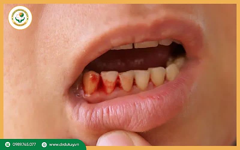 Triệu chứng viêm lợi loét hoại tử cấp