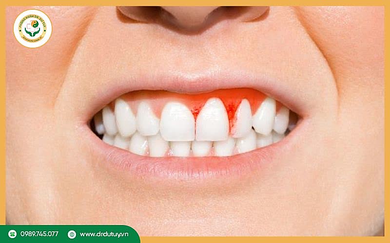 Điều trị viêm lợi loét hoại tử cấp