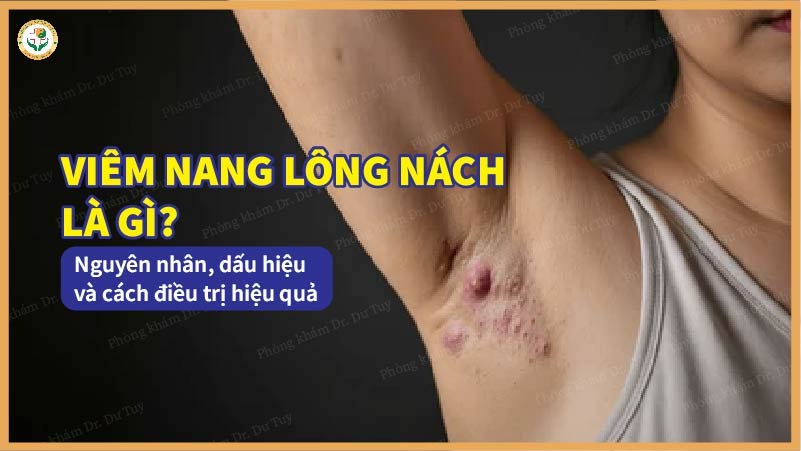 Viêm nang lông nách là gì? Nguyên nhân, dấu hiệu và cách điều trị hiệu quả