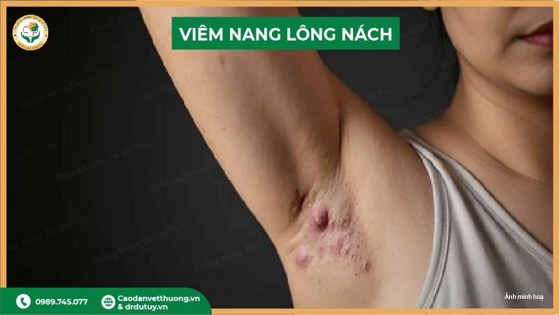 viêm nang lông nách