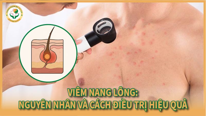 Viêm nang lông: Nguyên nhân và cách điều trị hiệu quả