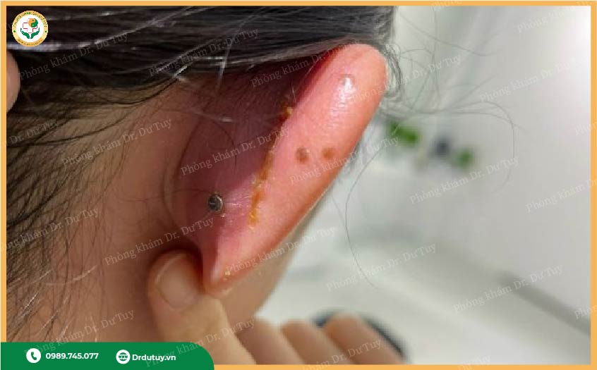 viêm sụn vành tai