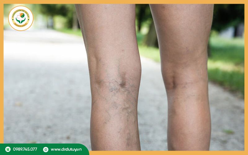 Viêm tắc tĩnh mạch chi dưới: Nguyên nhân và cách điều trị