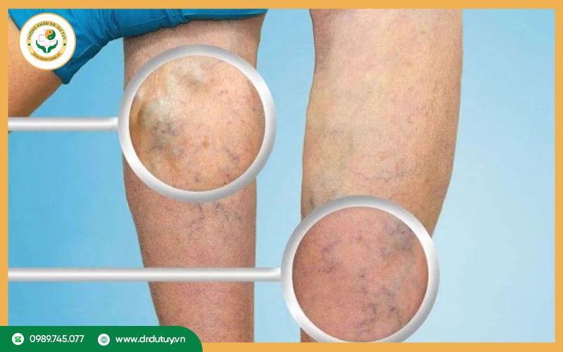 Viêm tắc tĩnh mạch chi dưới là gì?