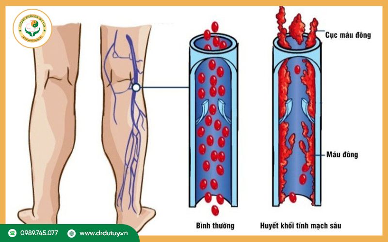 Nguyên nhân gây viêm tắc tĩnh mạch chi dưới
