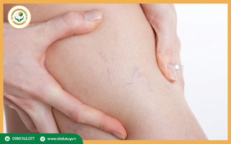Triệu chứng viêm tắc tĩnh mạch chi dưới