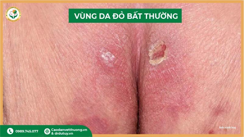 vùng da đỏ bất thường do loét tỳ đè