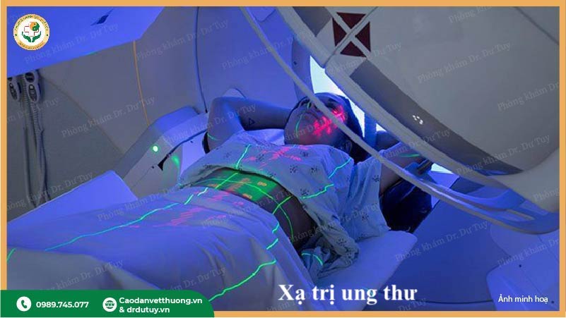 xạ trị điều trị ung thư hạch