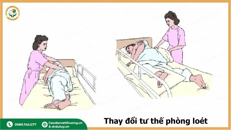 xoay trở bệnh nhân phòng bệnh
