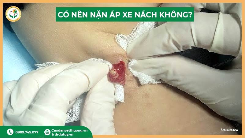 xử lý áp xe tại cơ sở y tế